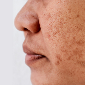 Dark Spot Solution